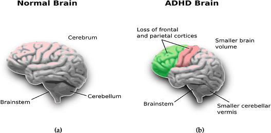 ADHD Brain vs. Normal Brain: What Scans Reveal