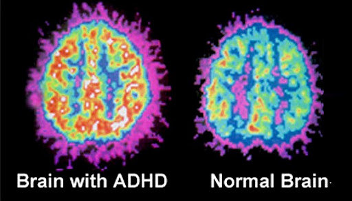 ADHD Brain vs. Normal Brain: What Scans Reveal