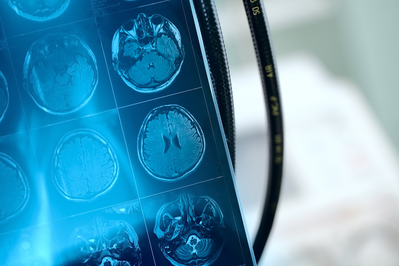 How to Treat ADHD and Anxiety in Adults